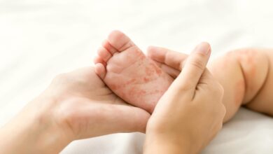 Measles cases among children hit 50 in North London
